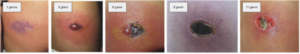 Progressione degli effetti di un morso verificato di ragno violino sul lato destro del tronco di una persona (indicata con numero di giorni post morso). Foto presa e modificata da Shahi et al., 2014.